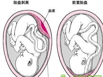 前置胎盘示意图