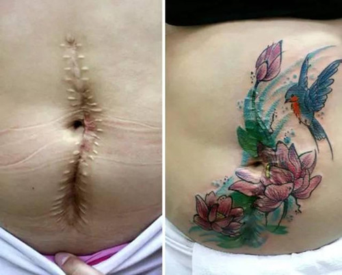 剖腹产妈妈留下的伤痕