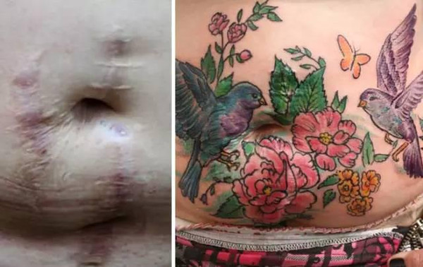 剖腹产疤痕