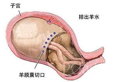 剖腹产示意图