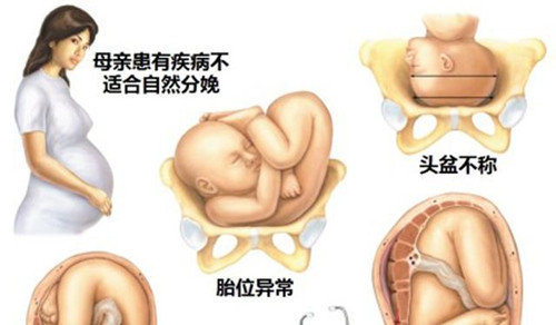 不适合顺产的产妇